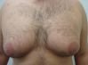 liposuction-chest-before-after-photo-382-10-e1393176910104.jpg